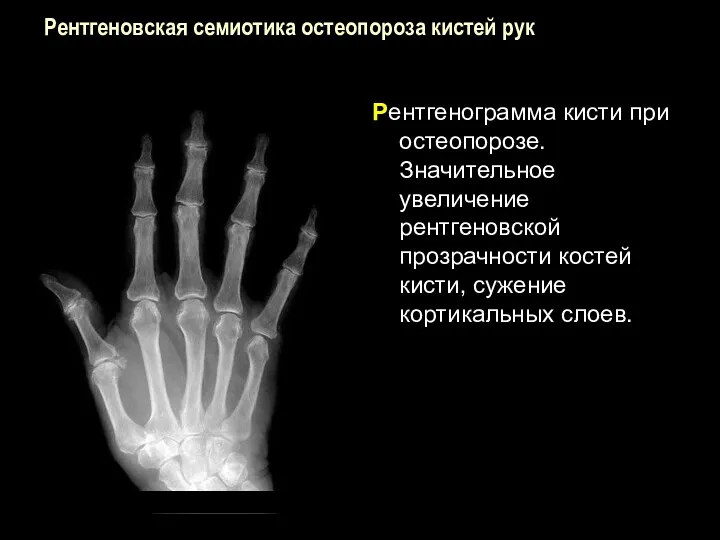 Рентгеновская семиотика остеопороза кистей рук Рентгенограмма кисти при остеопорозе. Значительное увеличение рентгеновской прозрачности