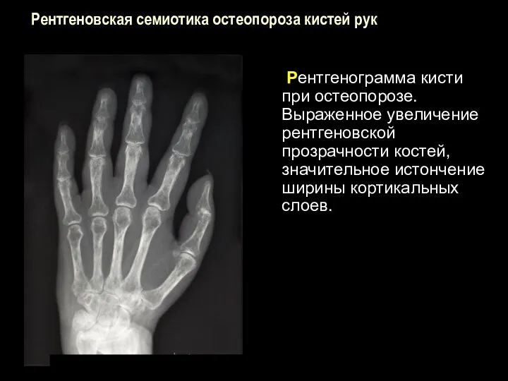 Рентгеновская семиотика остеопороза кистей рук Рентгенограмма кисти при остеопорозе. Выраженное увеличение рентгеновской прозрачности