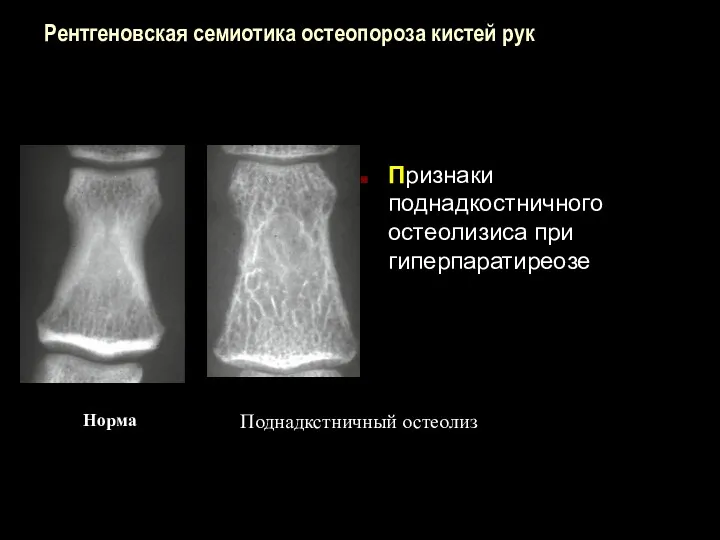 Рентгеновская семиотика остеопороза кистей рук Признаки поднадкостничного остеолизиса при гиперпаратиреозе Норма Поднадкстничный остеолиз