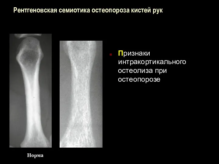 Рентгеновская семиотика остеопороза кистей рук Признаки интракортикального остеолиза при остеопорозе Норма