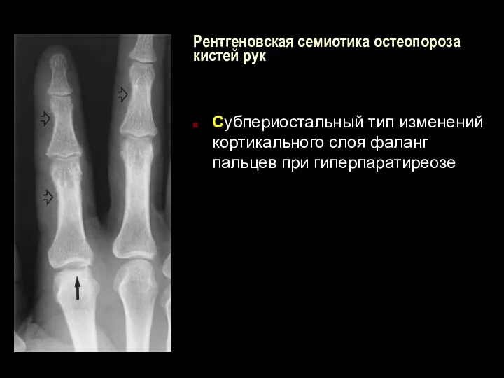 Рентгеновская семиотика остеопороза кистей рук Субпериостальный тип изменений кортикального слоя фаланг пальцев при гиперпаратиреозе
