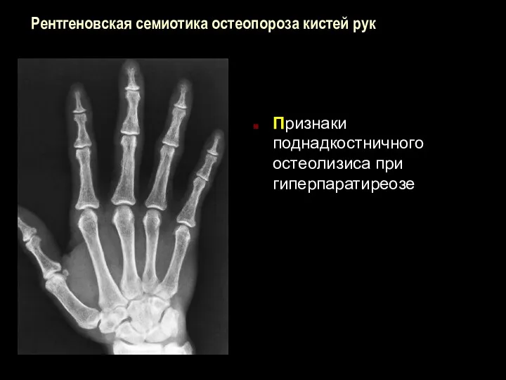 Рентгеновская семиотика остеопороза кистей рук Признаки поднадкостничного остеолизиса при гиперпаратиреозе