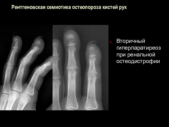 Рентгеновская семиотика остеопороза кистей рук Вторичный гиперпаратиреоз при ренальной остеодистрофии