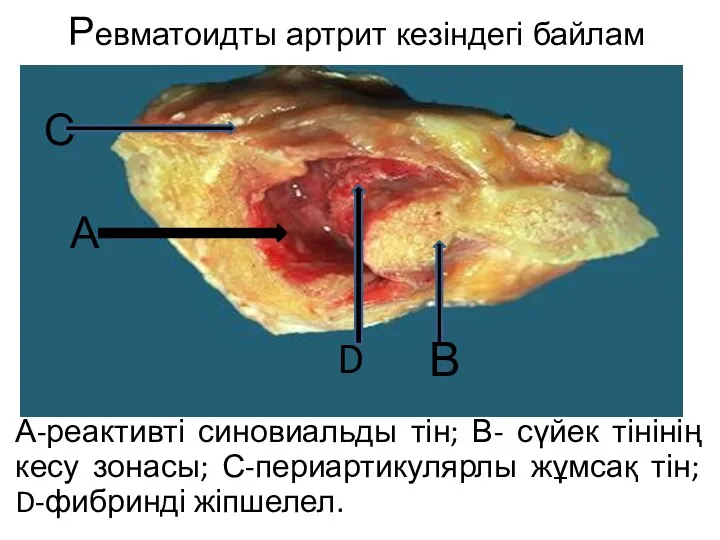 Ревматоидты артрит кезіндегі байлам А-реактивті синовиальды тін; В- сүйек тінінің