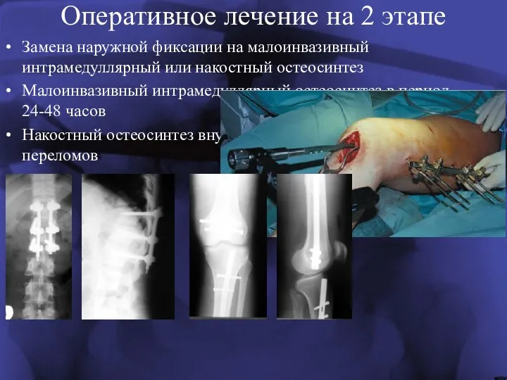 Оперативное лечение на 2 этапе Замена наружной фиксации на малоинвазивный