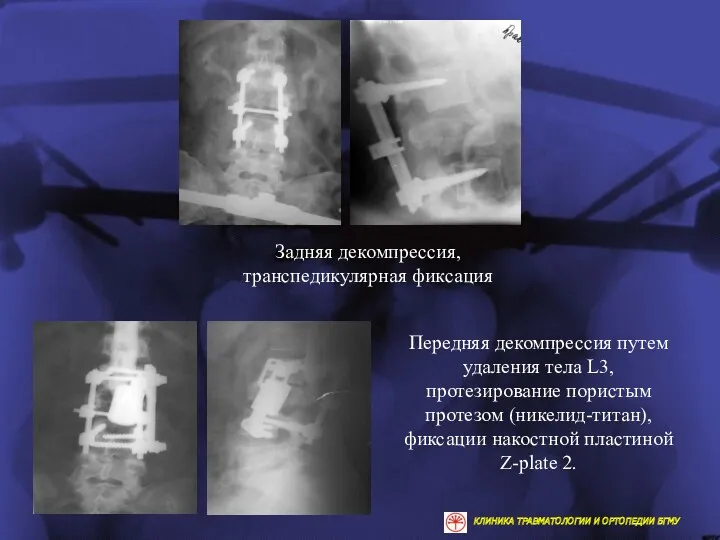 Задняя декомпрессия, транспедикулярная фиксация Передняя декомпрессия путем удаления тела L3,