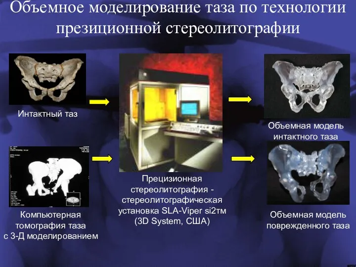 Объемное моделирование таза по технологии презиционной стереолитографии Компьютерная томография таза