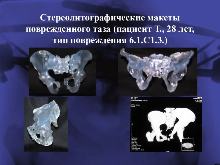 Стереолитографические макеты поврежденного таза (пациент Т., 28 лет, тип повреждения 6.1.С1.3.)