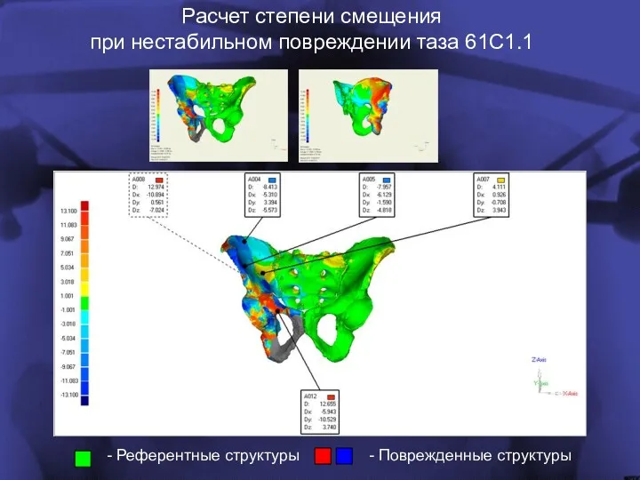 - Референтные структуры - Поврежденные структуры Расчет степени смещения при нестабильном повреждении таза 61С1.1