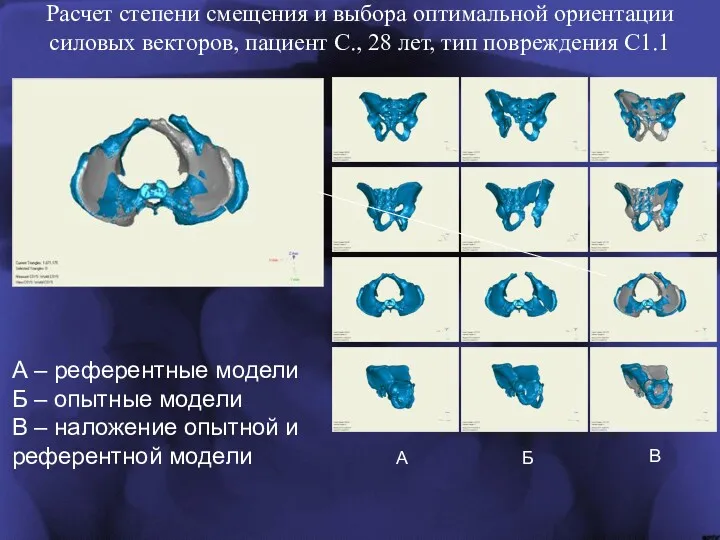 Расчет степени смещения и выбора оптимальной ориентации силовых векторов, пациент