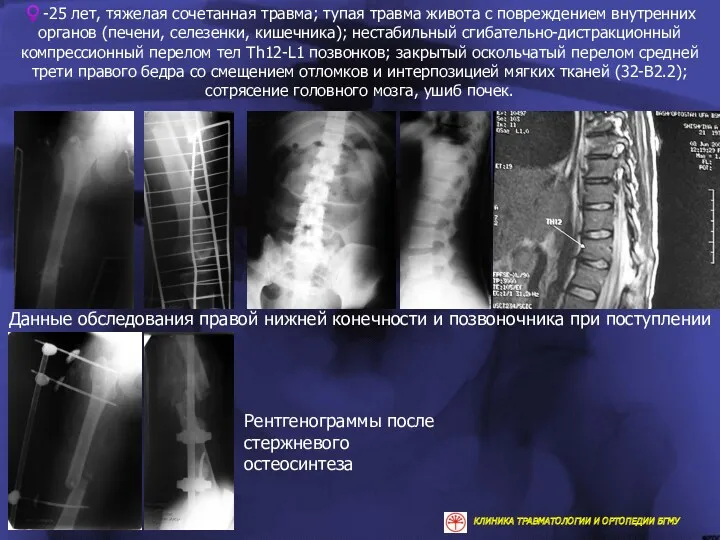 ♀-25 лет, тяжелая сочетанная травма; тупая травма живота с повреждением