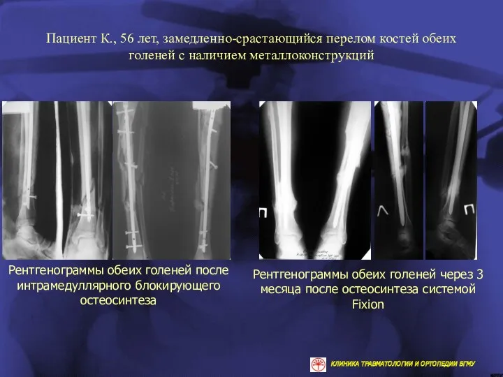 Пациент К., 56 лет, замедленно-срастающийся перелом костей обеих голеней с