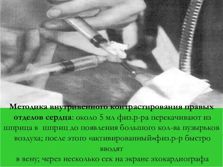 Методика внутривенного контрастирования правых отделов сердца: около 5 мл физ.р-ра