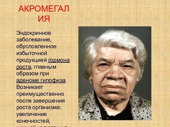 АКРОМЕГАЛИЯ Эндокринное заболевание, обусловленное избыточной продукцией гормона роста, главным образом