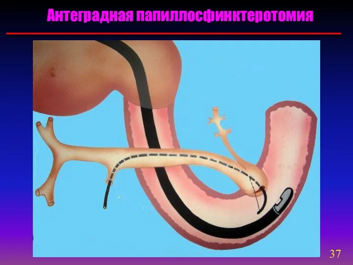Антеградная папиллосфинктеротомия