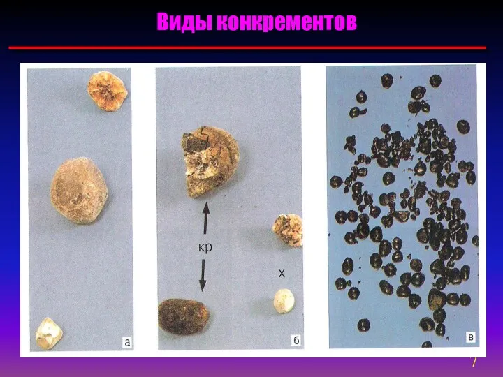 Виды конкрементов