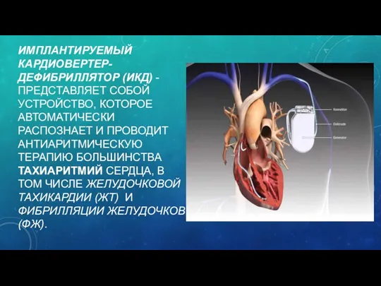 ИМПЛАНТИРУЕМЫЙ КАРДИОВЕРТЕР-ДЕФИБРИЛЛЯТОР (ИКД) - ПРЕДСТАВЛЯЕТ СОБОЙ УСТРОЙСТВО, КОТОРОЕ АВТОМАТИЧЕСКИ РАСПОЗНАЕТ