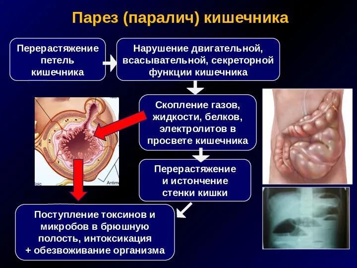 Парез (паралич) кишечника Скопление газов, жидкости, белков, электролитов в просвете