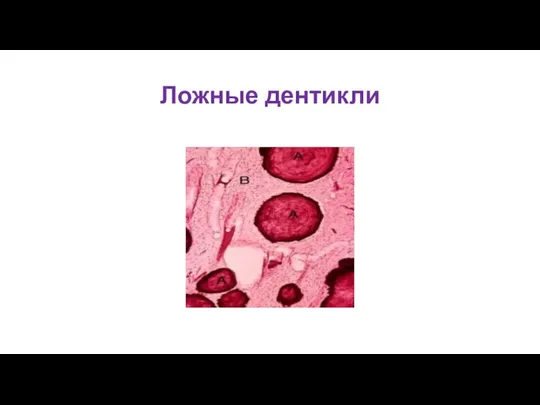 Ложные дентикли