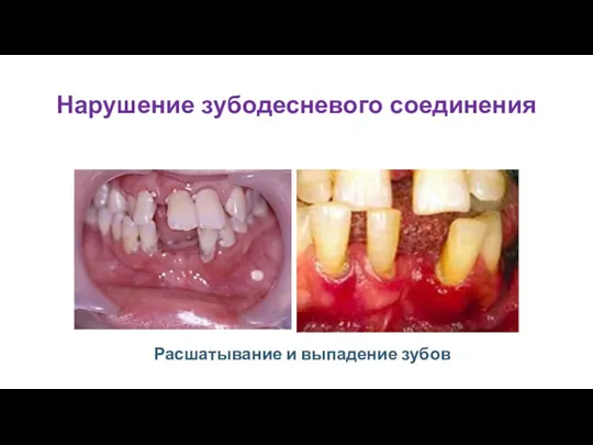 Нарушение зубодесневого соединения Расшатывание и выпадение зубов