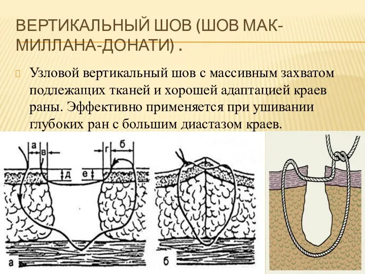 ВЕРТИКАЛЬНЫЙ ШОВ (ШОВ МАК-МИЛЛАНА-ДОНАТИ) . Узловой вертикальный шов с массивным