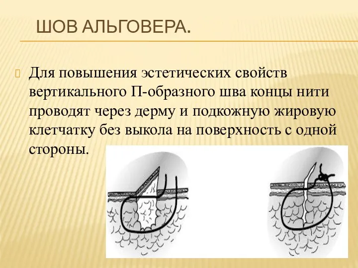 ШОВ АЛЬГОВЕРА. Для повышения эстетических свойств вертикального П-образного шва концы