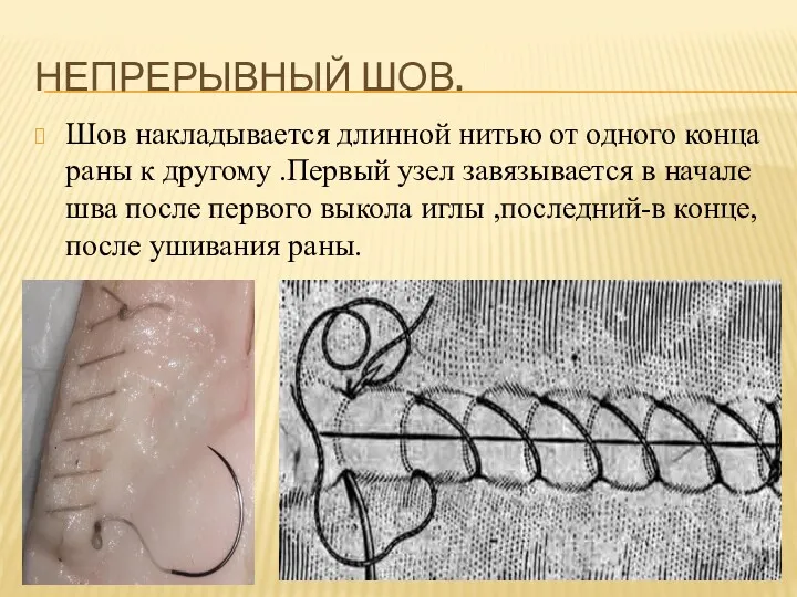 НЕПРЕРЫВНЫЙ ШОВ. Шов накладывается длинной нитью от одного конца раны