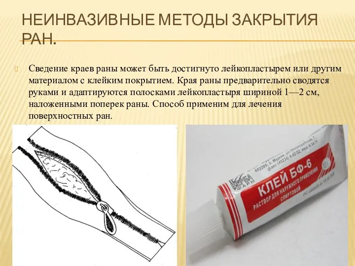 НЕИНВАЗИВНЫЕ МЕТОДЫ ЗАКРЫТИЯ РАН. Сведение краев раны может быть достигнуто