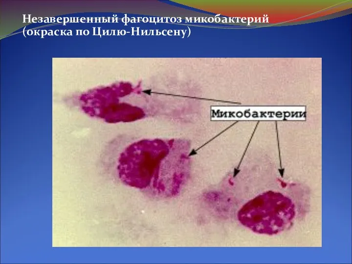 Незавершенный фагоцитоз микобактерий (окраска по Цилю-Нильсену)