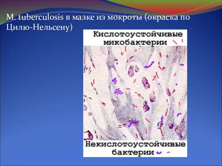 M. tuberculosis в мазке из мокроты (окраска по Цилю-Нельсену)