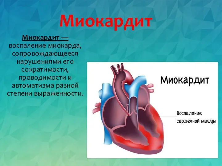 Миокардит Миокардит — воспаление миокарда, сопровождающееся нарушениями его сократимости, проводимости и автоматизма разной степени выраженности.