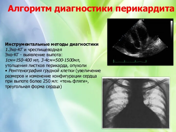 Инструментальные методы диагностики 1.Эхо-КГ и чреспищеводная Эхо-КГ - выявление выпота: