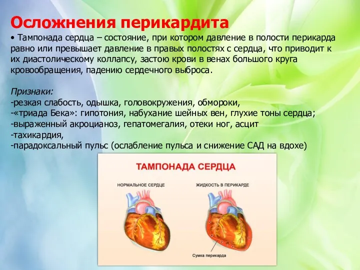 Осложнения перикардита • Тампонада сердца – состояние, при котором давление