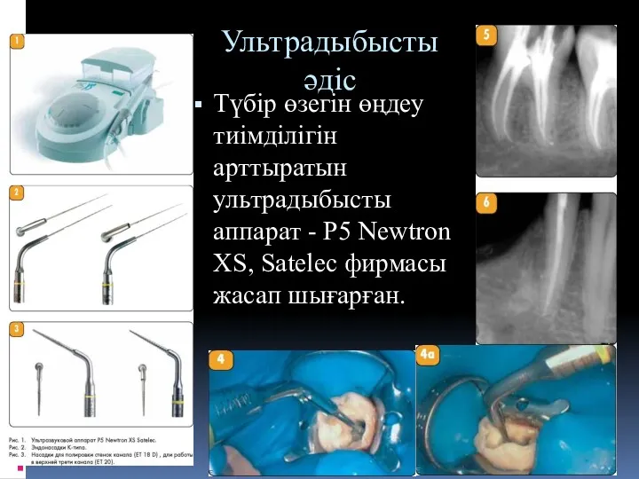 Ультрадыбысты әдіс Түбір өзегін өңдеу тиімділігін арттыратын ультрадыбысты аппарат -