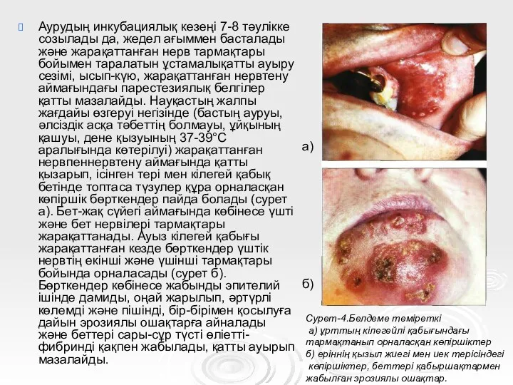 Аурудың инкубациялық кезеңі 7-8 тәулікке созылады да, жедел ағыммен басталады