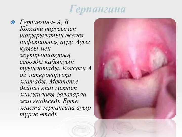 Герпангина Герпангина- А, В Коксаки вирусымен шақырылатын жедел инфекциялық ауру.