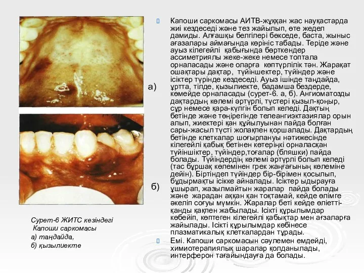 Капоши саркомасы АИТВ-жұққан жас науқастарда жиі кездеседі және тез жайылып,