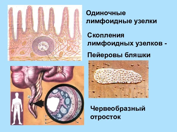 Одиночные лимфоидные узелки Скопления лимфоидных узелков - Пейеровы бляшки Червеобразный отросток