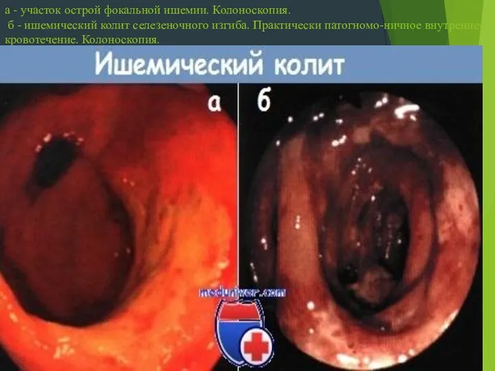 а - участок острой фокальной ишемии. Колоноскопия. б - ишемический