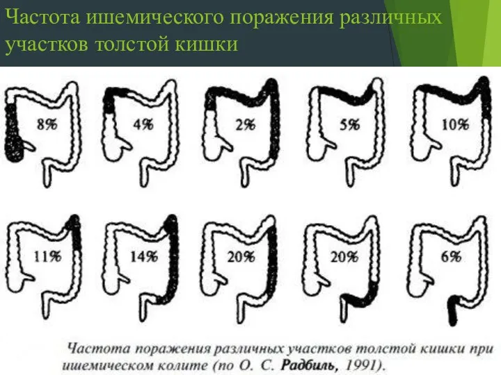 Частота ишемического поражения различных участков толстой кишки