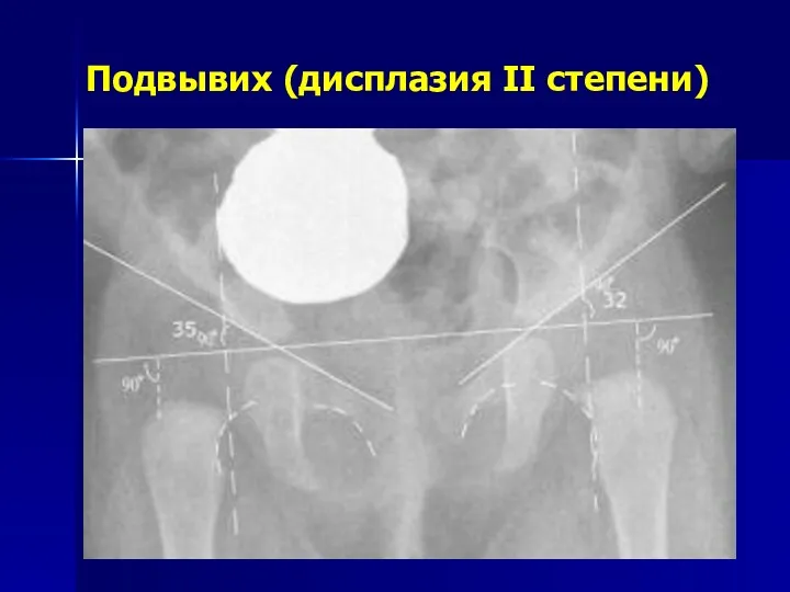 Подвывих (дисплазия II степени)