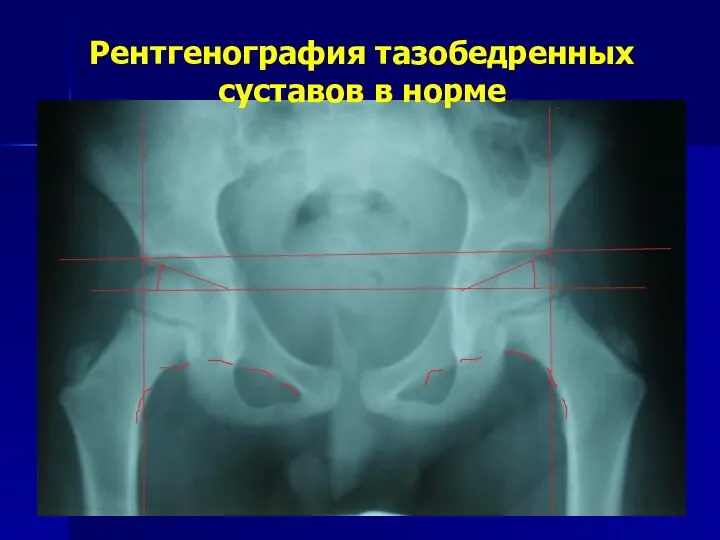 Рентгенография тазобедренных суставов в норме