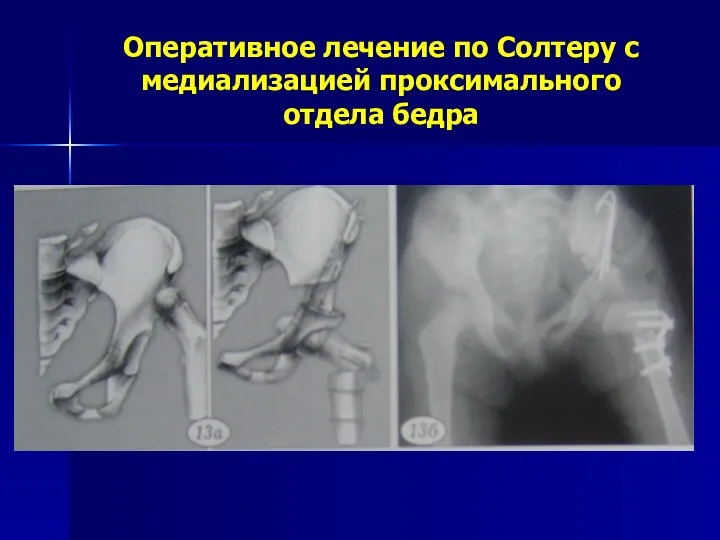 Оперативное лечение по Солтеру с медиализацией проксимального отдела бедра