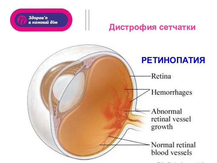 Дистрофия сетчатки РЕТИНОПАТИЯ