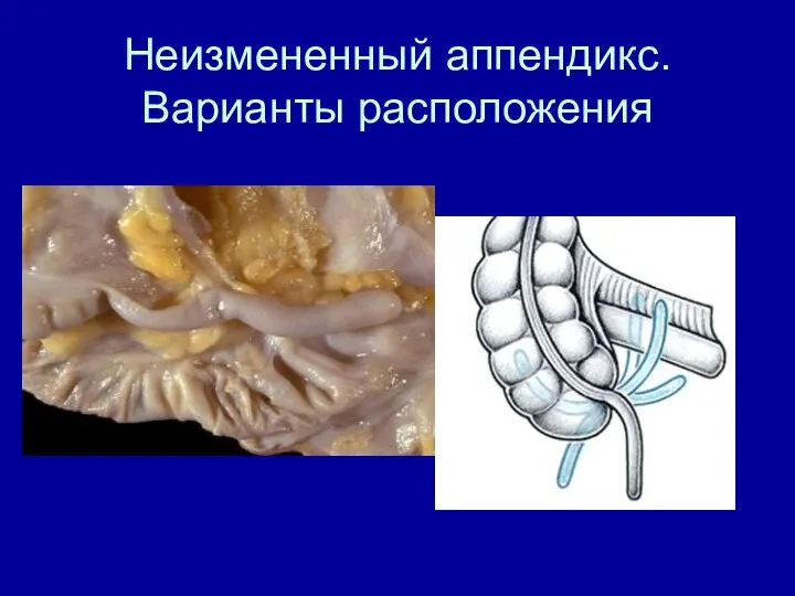 Неизмененный аппендикс. Варианты расположения