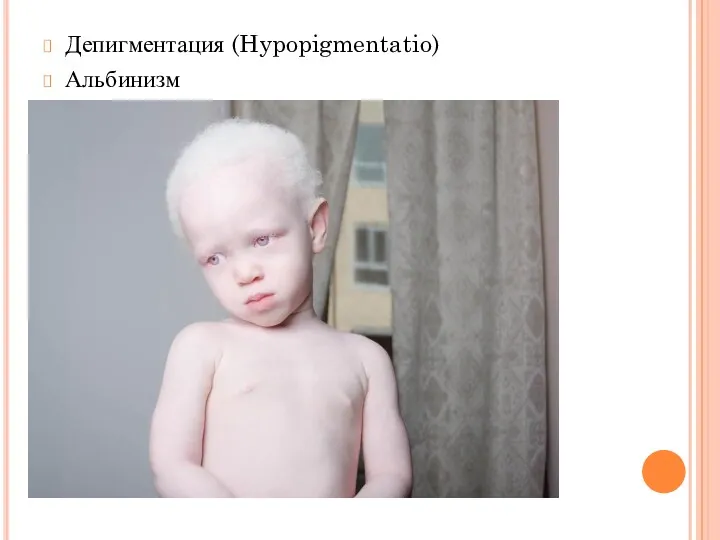 Депигментация (Hypopigmentatio) Альбинизм