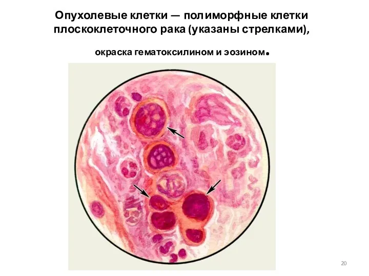 Опухолевые клетки — полиморфные клетки плоскоклеточного рака (указаны стрелками), окраска гематоксилином и эозином.