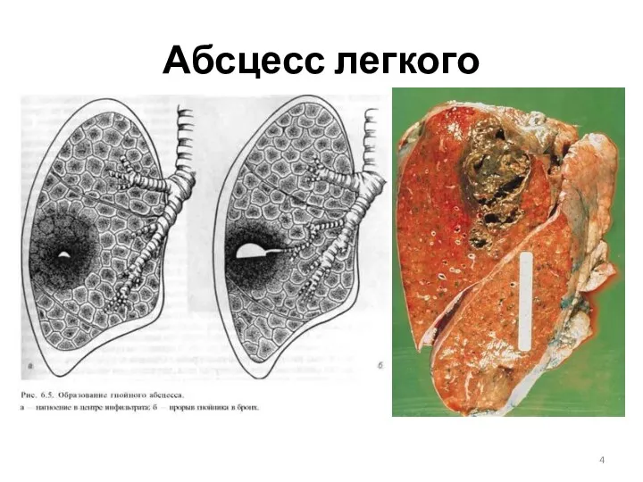 Абсцесс легкого