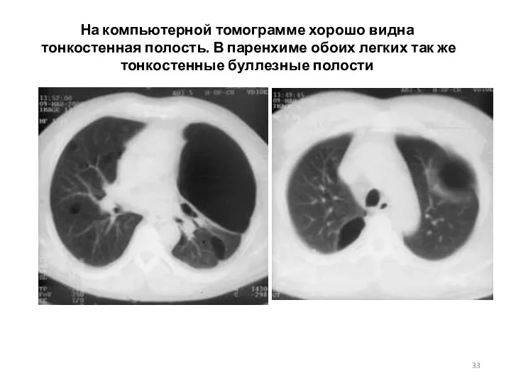 На компьютерной томограмме хорошо видна тонкостенная полость. В паренхиме обоих легких так же тонкостенные буллезные полости