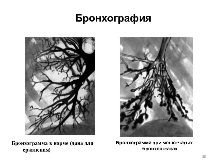 Бронхография Бронхограмма при мешотчатых бронхоэктазах Бронхограмма в норме (дана для сравнения)